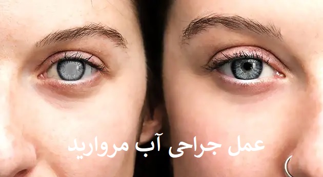 عمل جراحی آب مروارید