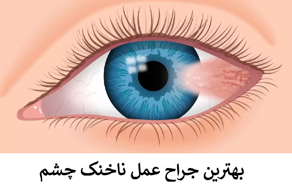 بهترین جراح عمل ناخنک چشم