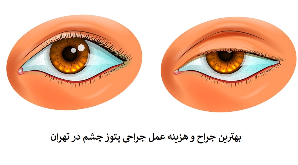 بهترین جراح و هزینه عمل جراحی پتوز چشم در تهران