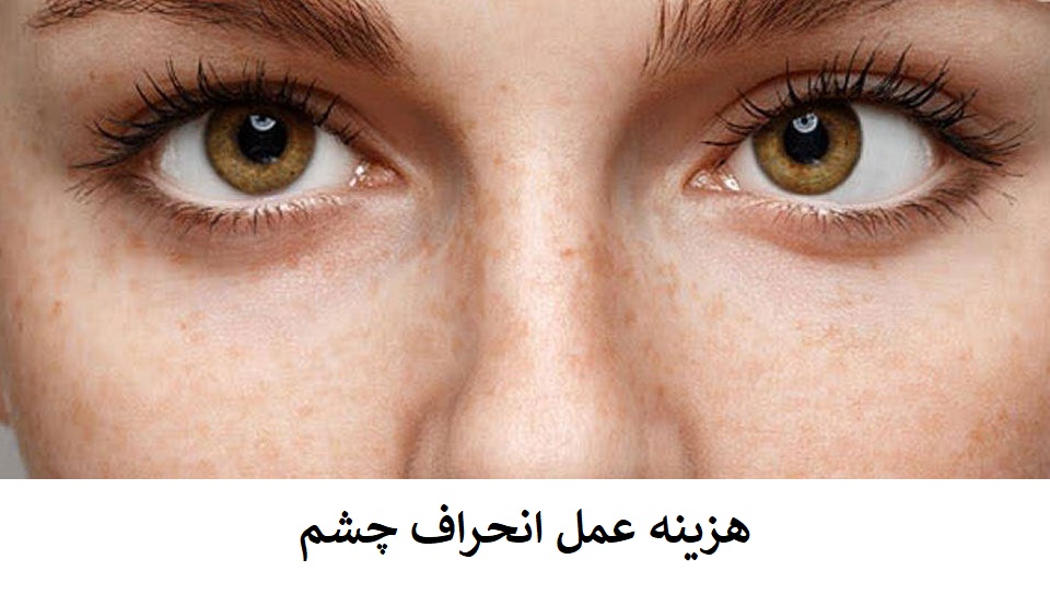 هزینه عمل انحراف چشم