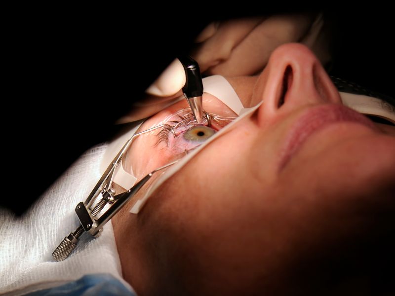 هزینه عمل لیزیک ، لازک و فمتولیزیک چشم در تبریز