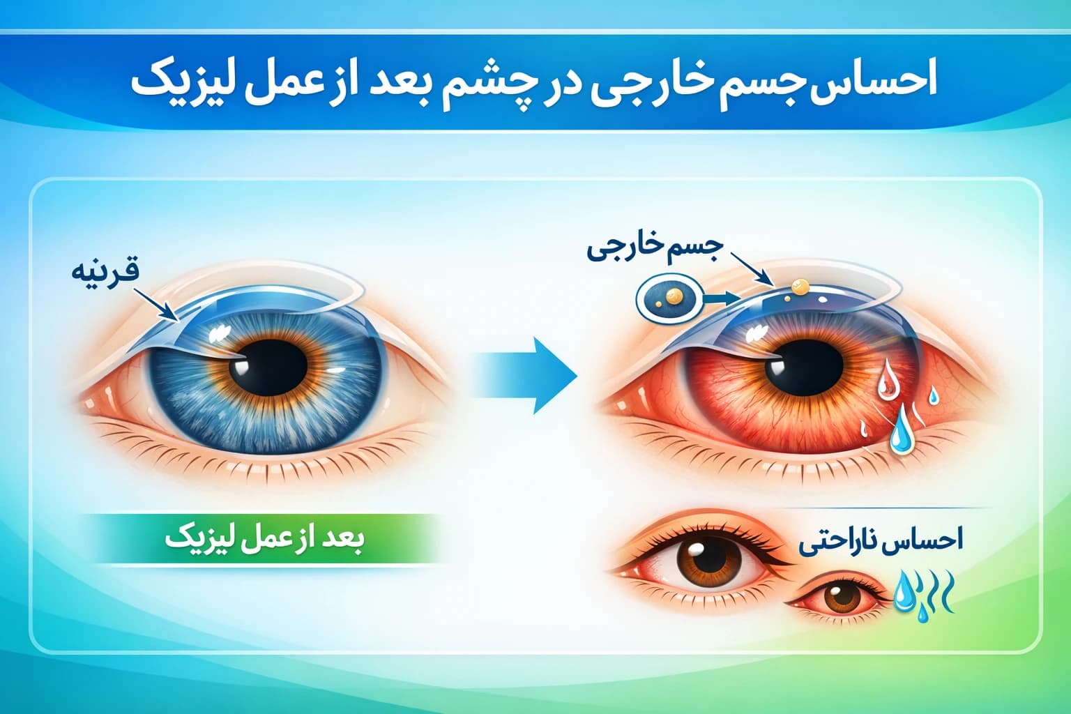 احساس جسم خارجی در چشم بعد از عمل لیزیک