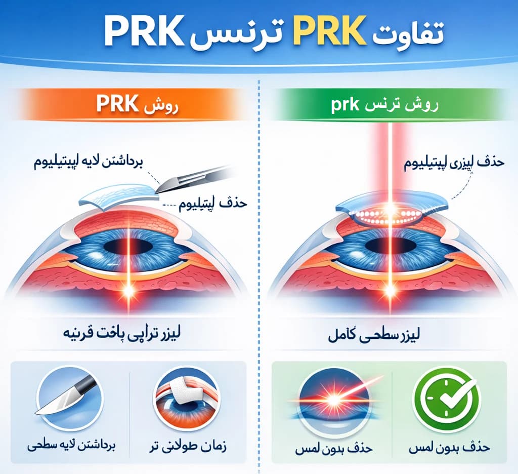 تفاوت prk و ترنس prk