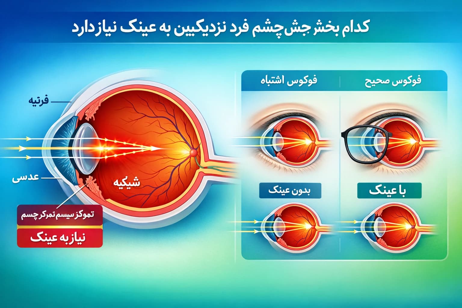 کدام بخش چشم فرد نزدیک بین به عینک نیاز دارد
